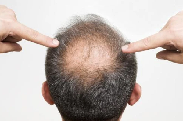 Hair Loss